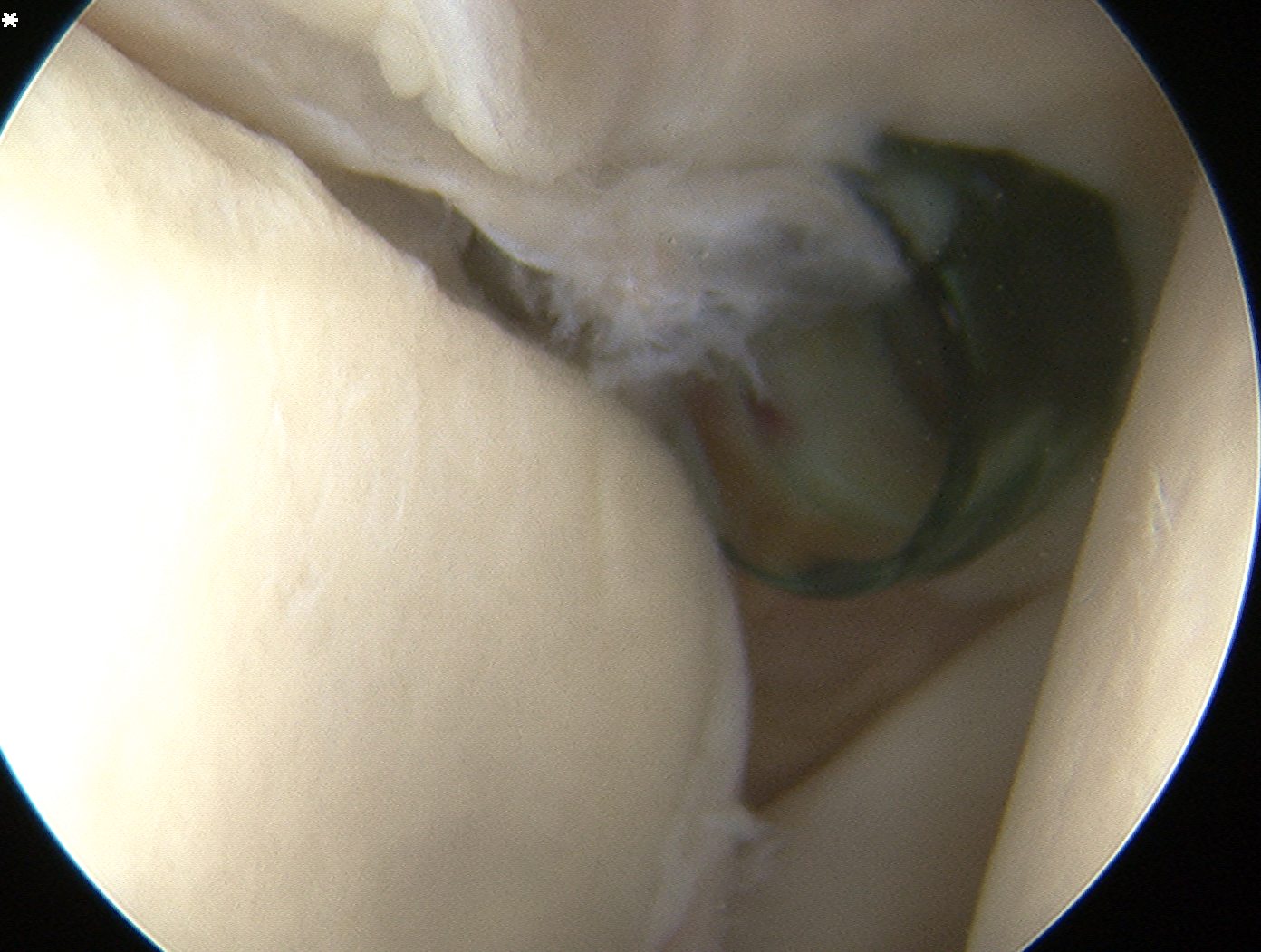 Anterosuperior Glenohumeral portal